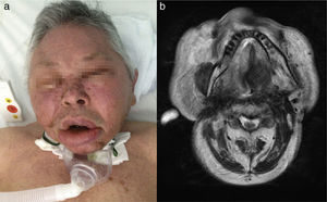 (a) A 67-year-old man with massive facial edema and extensive neck fibrosis. (b) Axial computed tomography image showing an increase in volume of the soft tissues.