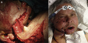 (a) Tubular deltopectoral flap in the subcutaneous pocket in the patient's cheek. (b) Image of the patient 72h after surgery.