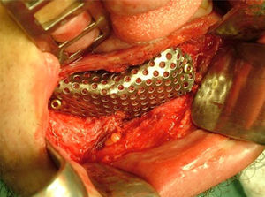 Regeneración ósea guiada mediante hueso autólogo de cresta ilíaca y malla de titanio. La malla de se debe remover una vez oseointegrado el injerto.