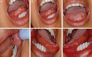 (a–f) Clinical intraoral exam, multiple ulcers measuring approximately 0.5–1.2cm in diameter, with an erythematous halo and fibrinolytic bed on the edge and back of the tongue, lips and bilateral jugal mucosa.