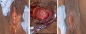 (a–c) Multiple ulcerations of the posterior vaginal wall of 1.5–2cm in diameter, with a hyperemia halo, painful on palpation, with abundant white liquid discharge.