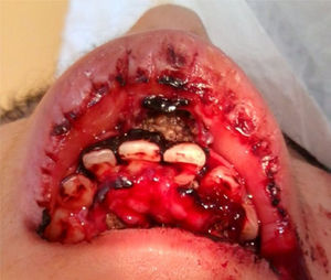 Infestación masiva de larvas maduras en la mucosa gingival del vestíbulo bucal anterior y superior. Cavidades larvarias en el frenillo labial superior y gran flujo sanguinolento. Examen regional de la cavidad oral.