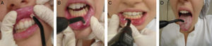 (a–d) Application of low power laser (GaAlAS) in each clinical lesion.
