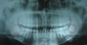 Ortopantomografía del paciente. Nótese la similitud en posición y forma de ambos terceros molares inferiores.
