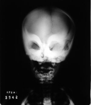 Antero-posterior radiograph of the face. Note a higher radiopacity of the cortical bone of the maxilla and bilateral periorbital region.