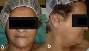 Foto clínica preoperatoria de la paciente. a) Vista frontal. b) Vista lateral. Se aprecia el aumento de volumen en la zona preauricular derecha.