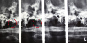 Radiografía de articulación temporomandibular bilateral a los 8 meses postoperatorio No se aprecian signos de la masa tumoral.