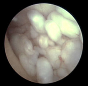 Imágenes intraoperatorias: artroscopia de la ATM izquierda mostrando múltiples CL distendiendo la cavidad articular.