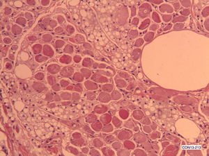 Hibernoma de cavidad oral. Se aprecia cómo la población de células adiposas microvacuoladas sin atipia infiltran entre los haces de músculo estriado (HE ×100).