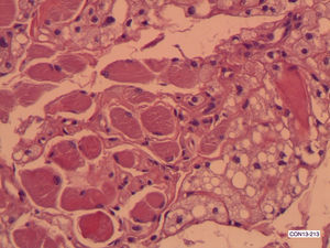 Hibernoma de cavidad oral. Aposición de células del hibernoma con miocitos estrellados. Detalle (HE ×200).