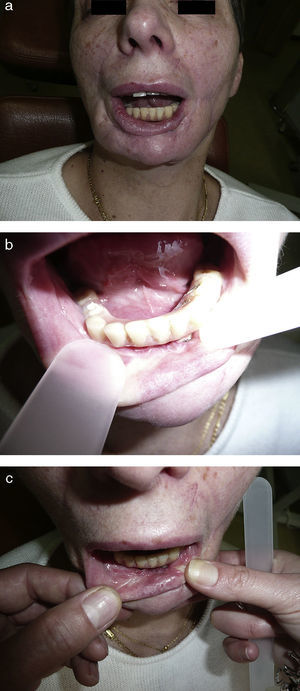 A. Aspecto clínico en mayo de 2008, 18 años después del diagnóstico inicial. Se observa el aspecto cicatricial de las partes blandas labiomentonianas, consecuencia de las cirugías efectuadas. A pesar de dificultad de evidenciar claramente una masa tumoral las biopsias son positivas para carcinoma esclerosante con invasión ósea en la sínfisis mandibular. B. No hay alteraciones al nivel del suelo de la boca. C. Aspecto cicatricial de la mucosa labial sin poder evidenciar claramente una masa tumoral.