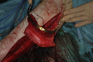 Reconstrucción mandibular utilizando un colgajo microvascularizado tipo peroné y una barra mandibular.