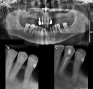 a) Ortopantomografía inicial con lesión radiolúcida entre 3.4 y 3.5; b) radiografía periapical inicial; c) radiografía periapical tras tratamiento endodóncico del 3.4.