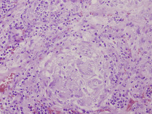 Corte histológico donde se observa granuloma necrosante en tejido glandular parotídeo. Aumento 796 × 599. Tinción hematoxilina-eosina.