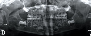 Imagen radiolúcida multilocular de bordes corticalizados que compromete rama y ángulo mandibular derechos (flecha).