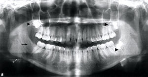 Agenesia de diente 48 (flecha), se observan dientes 18, 28, 38 en evolución intraósea (puntas de flecha).