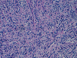 Sección de la tinción de hematoxilina-eosina de la muestra obtenida en la biopsia de la masa en la región de dermatoma mentoniano derecho. Las células tumorales muestran infiltración extensiva del nervio periférico y vainas de mielina.