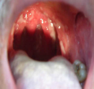 intraoral clinical examination observed oral lesions in hard and soft palate, in the oropharynx, extending tonsillar pillars, like painful irregular ulcer with yellowish points called beads Trélat.