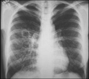 Chest's X-ray. Patient had sputum positive culture for M. tuberculosis and research Baar positive too.