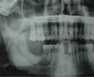 Ortopantomografía correspondiente al mismo paciente, donde se puede apreciar área de osteolisis en la región del ángulo mandibular derecho.