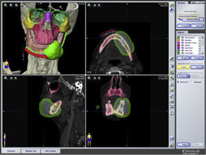Planificación virtual de los márgenes de resección de un carcinoma epidermoide con afectación mandibular y planificación de la reconstrucción.