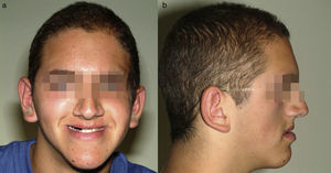 Visión frontal (a) y de perfil (b) pretratamiento a los 15 años.