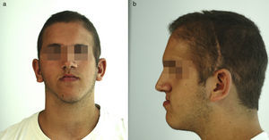 Visión frontal (a) y de perfil (b) pretratamiento a los 18 años.