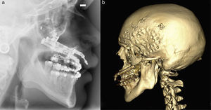 Imagen sagital del TC (a) y TC 3D (b) con los distractores óseos.