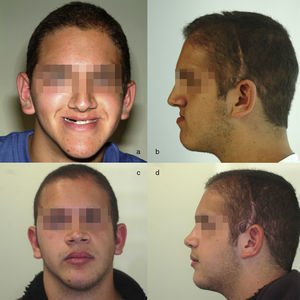 Visión frontal (a) y de perfil (b) antes de la distracción ósea y visión frontal (c) y de perfil (d) después de la cirugía ortognática.