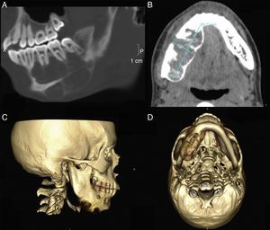TAC preoperatorio. A y B) Lesión expansiva en cuerpo mandibular derecho que se extiende a nivel basal y lingual, multilobulada y sin signos de rizolisis. C y D) Reconstrucción tridimensional.