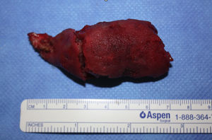 Imagen intraoperatoria de la pieza quirúrgica tras la cirugía de remodelado óseo.