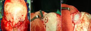 Imágenes intraoperatorias que muestran abombamiento del seno frontal (A); multifragmentación y remodelación de la pared anterior del seno conservando su mucosa (B) y reconstrucción de defecto óseo con malla reabsorbible (ácidos poliláctico y poliglicólico) (C).
