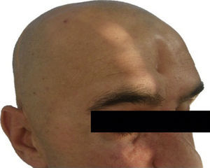 Defecto frontal secundario a estesioneuroblastoma. Imagen preoperatoria.