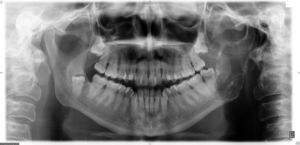 Imagen osteolítica mandibular que hizo sospechar el diagnóstico.