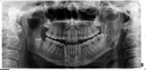 Osificación parcial de la lesión osteolítica en rama mandibular tras el tratamiento de quimio y radioterapia.