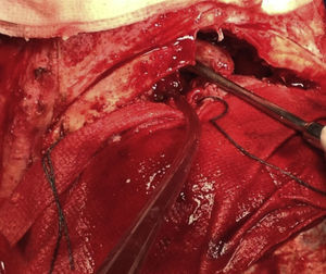 Imagen intraoperatoria. Abordaje bicoronal y craneotomía frontal anterior. La mucosa del mucocele se encuentra adherida a la región periorbitaria y a la duramadre subyacente, aunque sin signos de invasión.