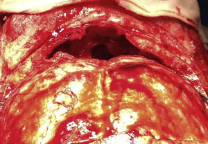 Imagen intraoperatoria. Resección completa del mucocele fronto-etmoidal gigante bilateral y etmoidectomía anterior completa.