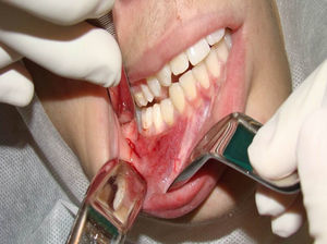 Clinical intraoral aspect showing a normal mucosa.