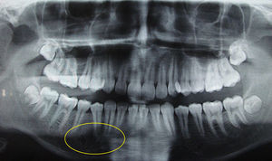 Panoramic radiograph showing bone repair at the lesion site follow-up 24 months.