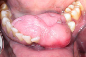 Intraoral clinical appearance of the lesion in anterior portion of lower border.