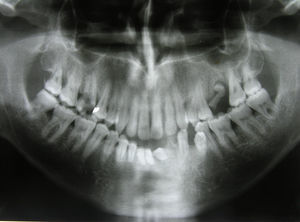 Panoramic radiograph evidencing tooth displacement due to lesion expansion.