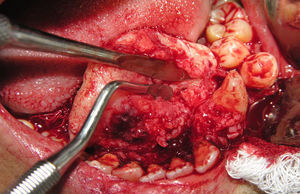 Displacement of the lesion.