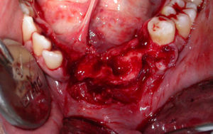 Surgical wound following total exeresis of the lesion and extraction of involved teeth.