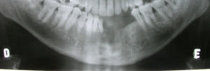 12-month radiographic follow-up showing absence of relapses.