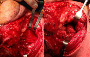 Imagen intraoperatoria: a) Exposición de zona prevertebral mediante abordaje cervical anterior externo; b) Extensa exostosis ósea anterior de C3-C4-C5.