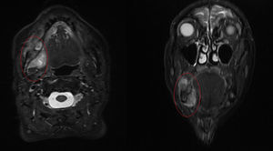 RMN: lesión tumoral expansiva en cuerpo y ángulo mandibular derecho.