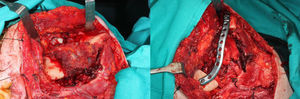 Fotografías intraoperatorias: lesión exofítica mandibular. Mandibulectomía segmentaria y reconstrucción con placa de osteosíntesis preformada.