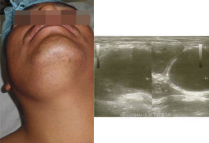 Tumoración blanda submandibular derecha. Estudio ecográfico de los tejidos blandos del cuello que evidencia glándula submaxilar derecha desplazada por la lesión descrita.