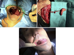 Pac. n.° 20. Reconstrucción de cara lateral lengua mediante buccinador de pedículo esqueletizado con arteria facial y venas concomitantes.
