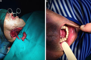Pac. n.° 18. Reconstrucción del suelo de boca con buccinador de pedículo esqueletizado con arteria facial y venas concomitantes.
